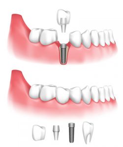 Dental Implant