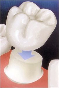 A porcelain veneer over an implant