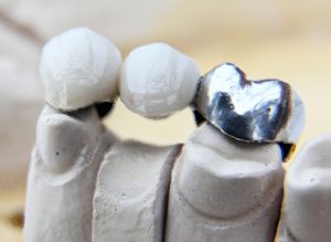 A bridge used to replace a missing tooth