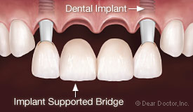 4 unit implant supported bridge