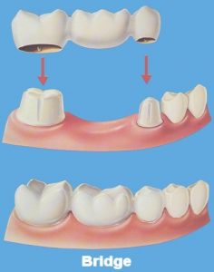 A dental bridge