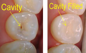 tooth colored filling over cavity