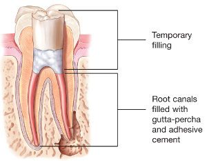 Illustration of the composite and gutta-percha fillings