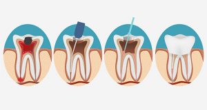 illustration of a root canal, step by step