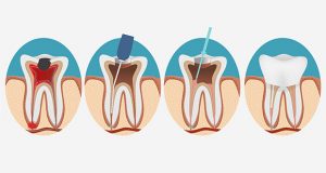 illustration of a root canal, step by step