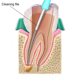 Illustration of a cleaning file used to clean a root canal