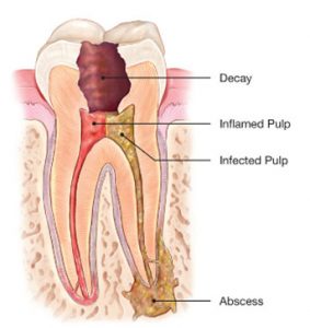 Anatomy of a diseased and inflamed tooth's root