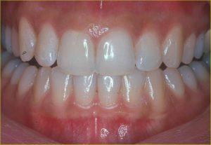 healthy gums