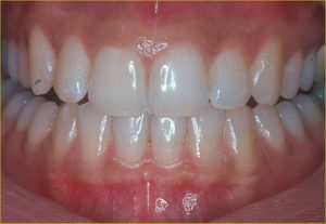 healthy gums