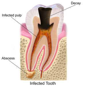 Abscessed tooth