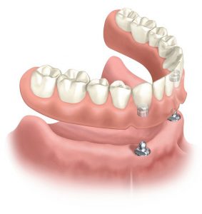 Implant Retained Denture