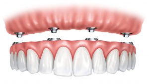 Implant Supported Denture