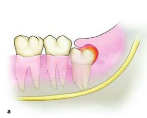 Soft Tissue Impaction