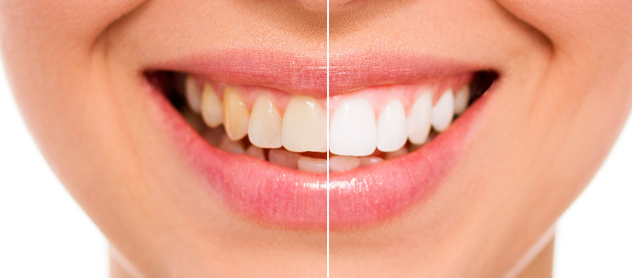 Before and After Teeth Whitening