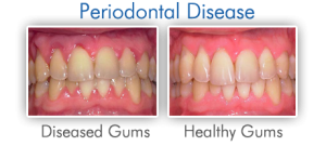 Gum Disease