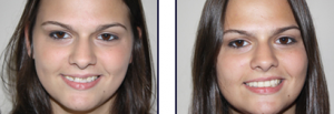 Smile Makeover 1